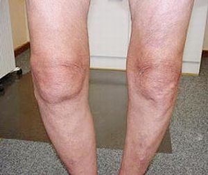Extensor și flexie contractura articulației genunchiului
