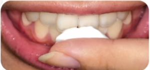 Remineralizantă gel gc dinte dinti mousse (myc mousse) comentarii instruire