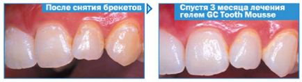 Remineralizantă gel gc dinte dinti mousse (myc mousse) comentarii instruire