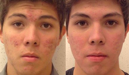 comentarii Roaccutane, instrucțiuni de utilizare, preț, analogi, efectele secundare (analogi Roaccutane) comentarii Roaccutane, instrucțiuni de utilizare, preț, analogi, efecte secundare