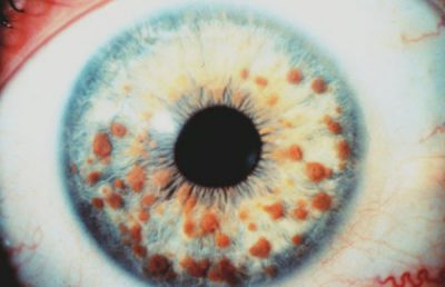 Alunița în ochi (nevul conjunctivei), ce să facă și cum să eliminați