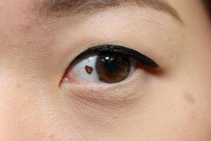Birthmark nev în coroidă ochiului, conjunctiva, iris, retină tratamentul