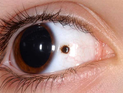 Birthmark în ochi și varietate de abordare a tratamentului