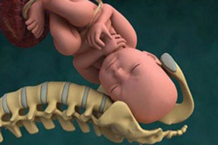 Genurile cu un pelvis îngust (naștere pelvis îngust) Genurile cu un pelvis îngust