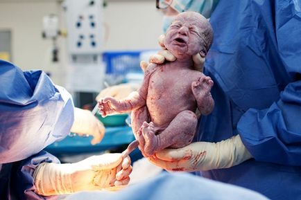 Genurile cu un pelvis îngust (naștere pelvis îngust) Genurile cu un pelvis îngust