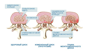 Simptomele de hernie spinării, cauzele și modul de a trata hernia vertebrale lombare