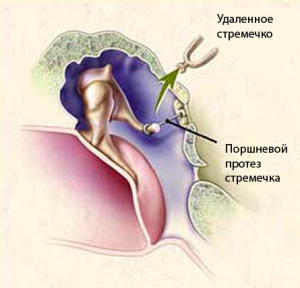 Simptomele și tratamentul otoscleroză
