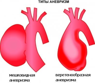 Simptomele, prevenirea și tratamentul abdominale anevrism aortic în