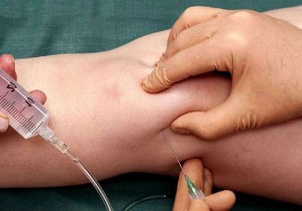 Lichidul sinovial în articulația genunchiului de tratament, simptomele și cauzele