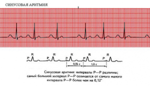 aritmie Sinus pe ECG