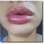 Vânătăi după acid hialuronic augmentarea buzelor; tratamentul mijloacelor hematom farmacie,