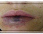 Vânătăi după acid hialuronic augmentarea buzelor; tratamentul mijloacelor hematom farmacie,