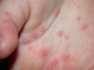 Rash ca un simptom al bolii (rash rash simptom bolii) Rash ca un simptom al bolii