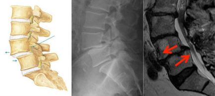 Deplasarea vertebrelor cervicale la adulți, simptome, tratament, consecințe