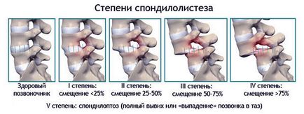 Deplasarea vertebrelor cervicale la adulți, simptome, tratament, consecințe
