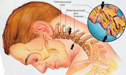 Deplasarea vertebrelor cervicale la adulți, simptome, tratament, consecințe