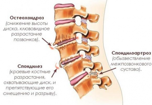 Spondiloza ce este