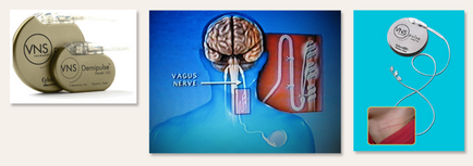 Stimulatori nervului vag in nipni ei