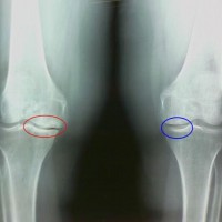 genunchiului spațiu comun instantaneu normale, restrânse, dureri articulare