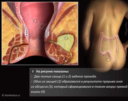Fistule rect (anus), ghid de adancime