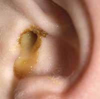 Flowing puroi din cauzele urechi, tratament
