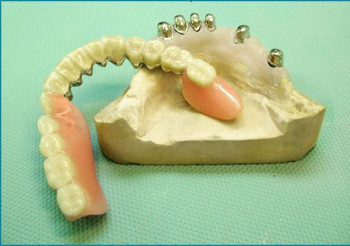 tehnologia de fabricare a protezelor dentare etape parțiale, costul