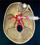 Doppler transcraniană (TCD)