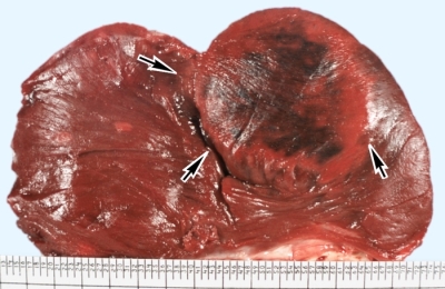infarct miocardic transmural ce prognoza, simptome și tratament