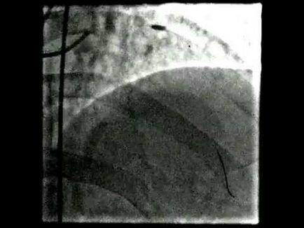 infarct miocardic transmural ce prognoza, simptome și tratament