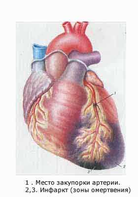 infarct miocardic transmural ce prognoza, simptome și tratament