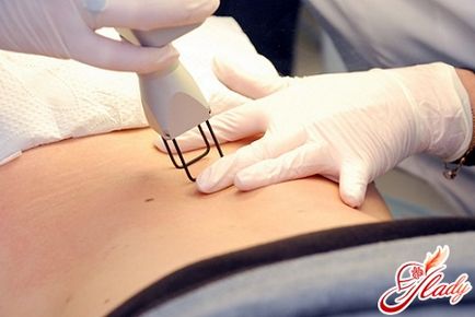 Eliminați vergeturi cu laser - dacă în picioare (în picioare) Eliminați vergeturi cu laser - dacă