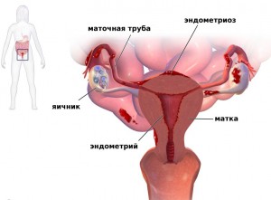 Efectele Histerectomia ale operațiunii