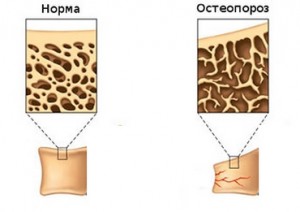 Efectele Histerectomia ale operațiunii