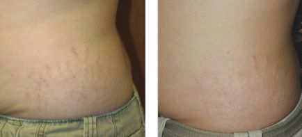 Îndepărtarea cu laser intindere - intindere dacă laser poate elimina (șterge) Eliminarea vergeturilor cu laser - dacă laser poate elimina vergeturile