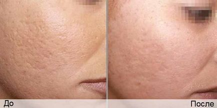 Tratamentul cu laser fotografie uimitoare de acnee, înainte și după