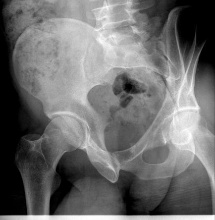 Renale urografie excretor, intravenos, obiectiv turistic (excretor) Renale urografie excretor, intravenos, obiectiv turistic