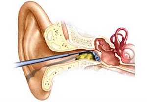 cauze tub de urechi, consecințe și soluții