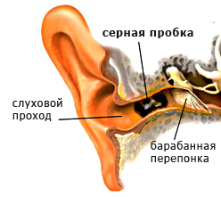 cauze Plug urechi, simptome, tratament