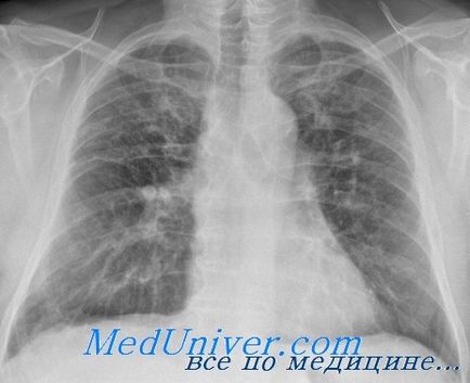Amplification, atenuarea și distorsiunea figura pulmonară