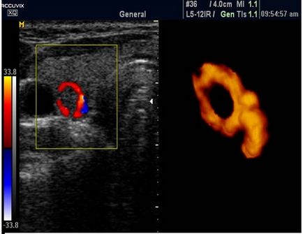 ecografie tiroidiană care prezinta tiroida cu ultrasunete, la fel ca și, în cazul în care