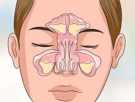 Vasotomy cornetelor ce este, provoacă o operațiune în partea de jos a nasului și a tipurilor sale