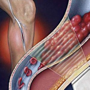 congestie venoasă în cap, picioare, pelvis și plămânii