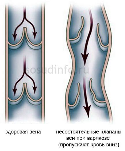 congestie venoasă în cap, picioare, pelvis și plămânii (picioare) congestie venoasă în cap, picioare, pelvis și plămânii