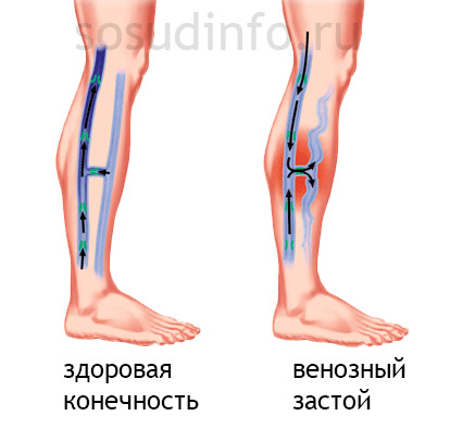 congestie venoasă în cap, picioare, pelvis și plămânii