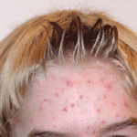 Tipuri de acnee pe față și corp, acnee fotografie diferite