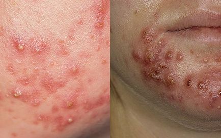 Tipuri de acnee pe fata sub piele acnee, apa, albastru și altele