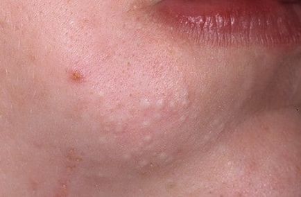 Tipuri de acnee descrierea și caracteristicile principalelor tipuri de acnee - Care sunt principalele diferențe