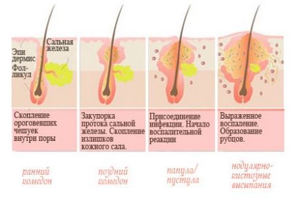 Tipuri de acnee descrierea și caracteristicile principalelor tipuri de acnee - Care sunt principalele diferențe