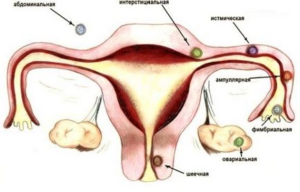 Fie vazut in ecografie sarcină ectopică