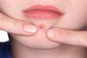 Cauzele interne ale acnee și tratamente